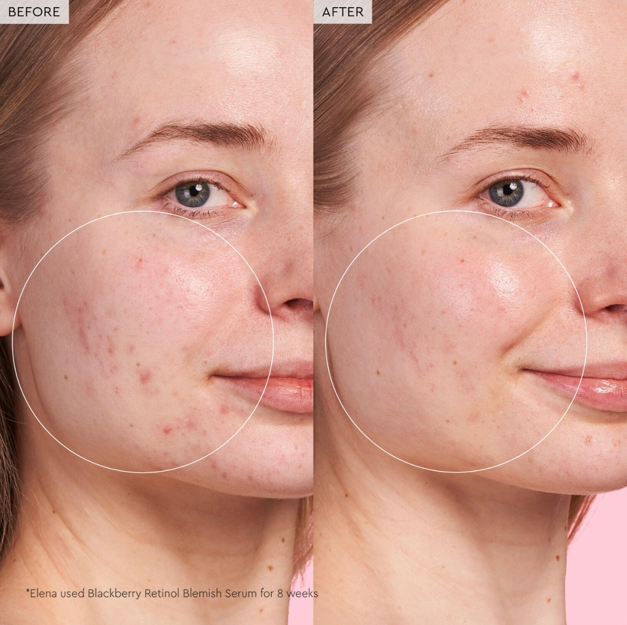 Blackberry Retinol Blemish Serum, 30ml